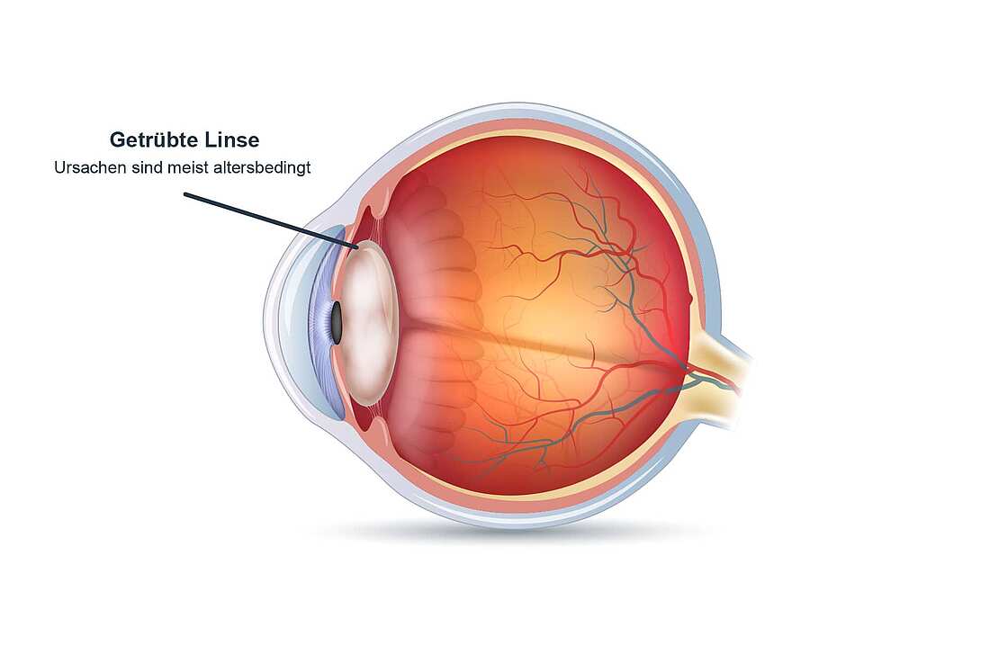 Grauer Star: Ursachen, Operationsmöglichkeit und passende Linsen für die  Augenkrankheit im Alter
