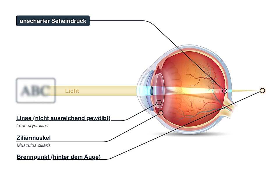 Grafik eines Augapfels mit Beschriftung der Symptome von Altersweitsichtigkeit (Alterssichtigkeit)