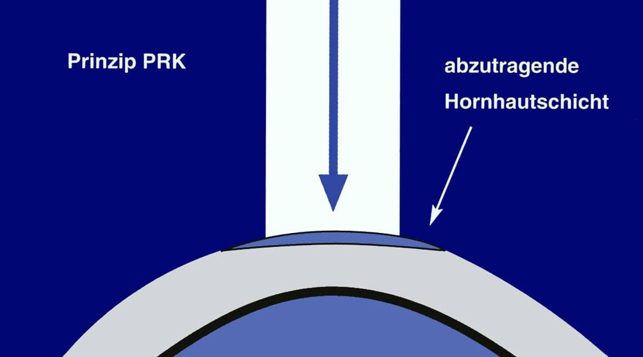 LASIK Operation